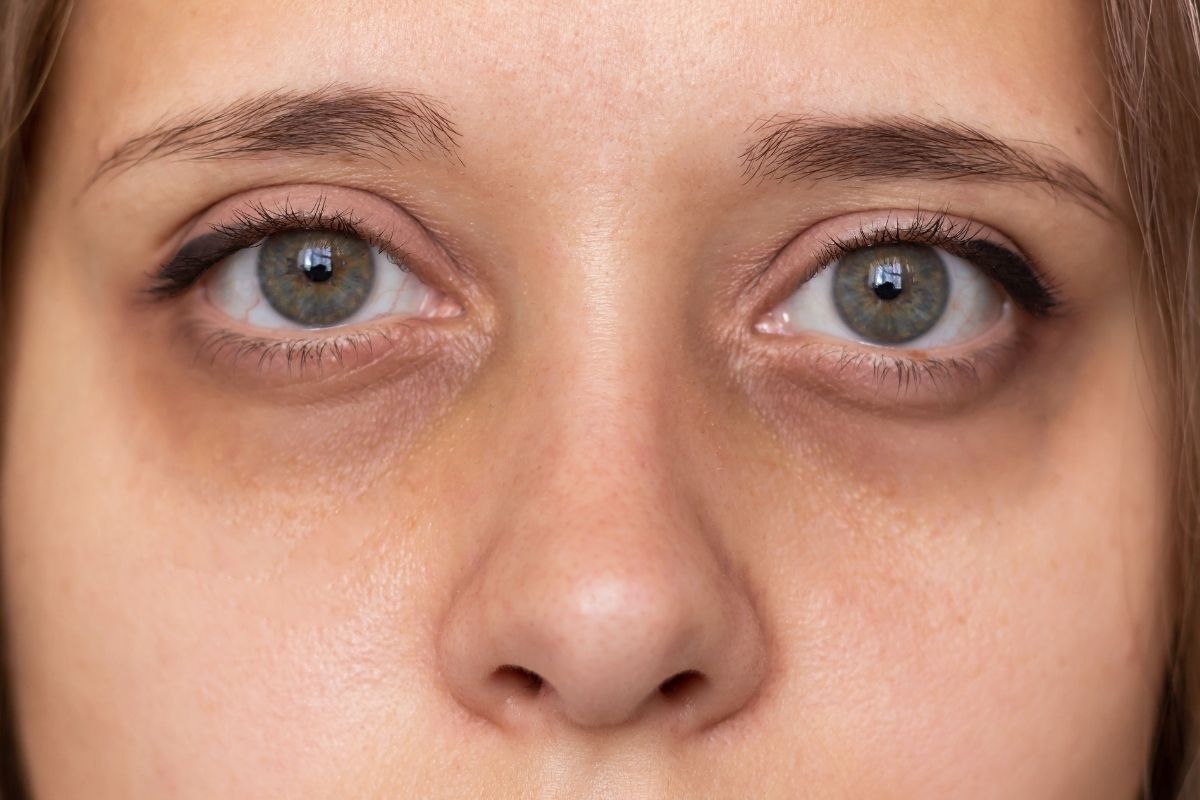 Under-Eye Area